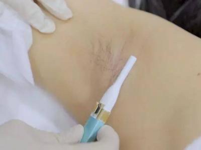 腋下脱毛后出汗多有异味怎么回事?腋下脱毛护理方法分享