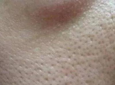 毛孔粗大怎么办 针对不同情况的毛孔粗大该如何护肤？
