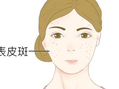 怎样祛斑快效果好