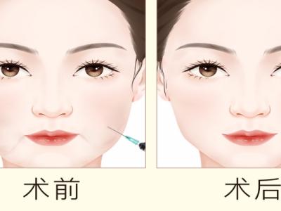 打溶脂针有副作用吗