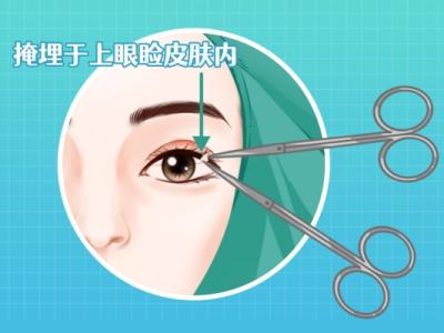双眼皮太宽了怎么修复