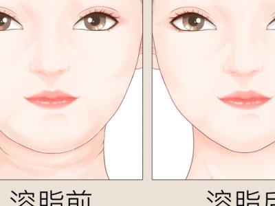 面部溶脂针副作用