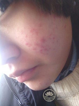 长青春痘怎么办？不同位置有不同药方