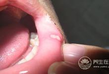 夏天口腔溃疡怎么办？5种水果助你排毒治病