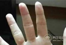冬季手上有冻疮怎么治