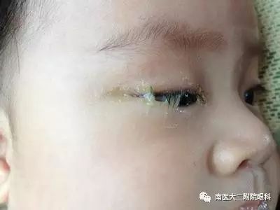 泪道阻塞的症状和危害有哪些？
