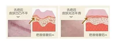 双眼皮术后出现上睑下垂怎么办？