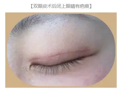 双眼皮术后出现上睑下垂怎么办？