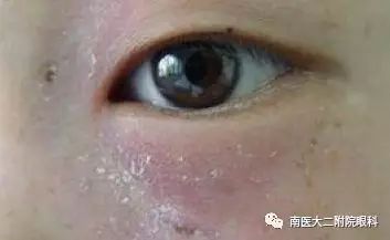 泪道阻塞的症状和危害有哪些？