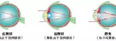 关于散光，这些你都了解吗？