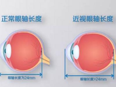 近视不可怕，度数越来越深才可怕