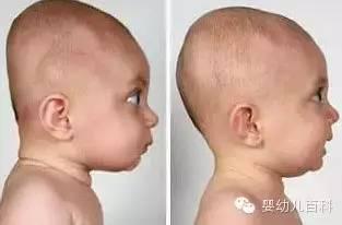 孩子的头型与睡枕头有关系吗？