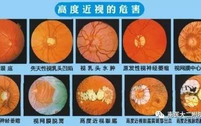高度近视患者注意六大事项