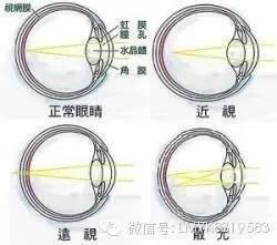 孩子近视+散光了怎么办?