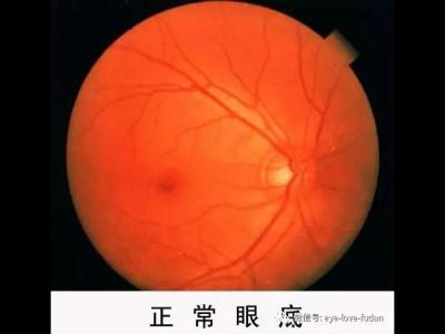 什么度数一直增加？戴镜度数加深的五大原因！