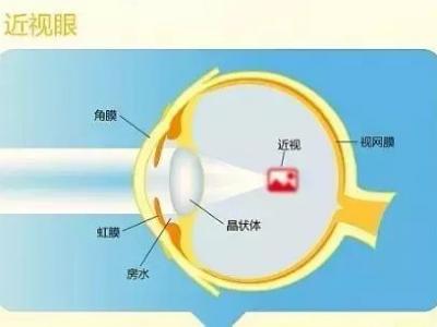 近视的原因、预防与治疗