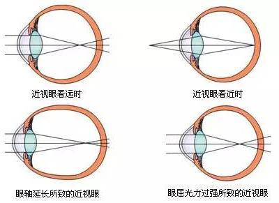 适龄儿童不论视力好坏都应该验光