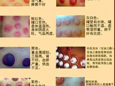 拔罐颜色症状对照表图解，深浅代表不同病症(越浅越好)